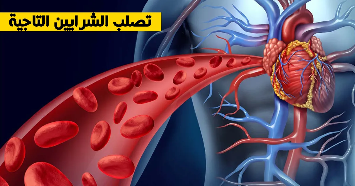 تصلب الشرايين التاجية